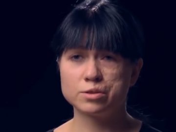 Лікар Валіхновський повернув красу молодій мамі зі шрамом на півобличчя. ВІДЕО