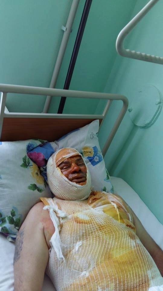 Шахтаря, який намагався вчинити акт самоспалення перевели до стаціонару. ФОТО