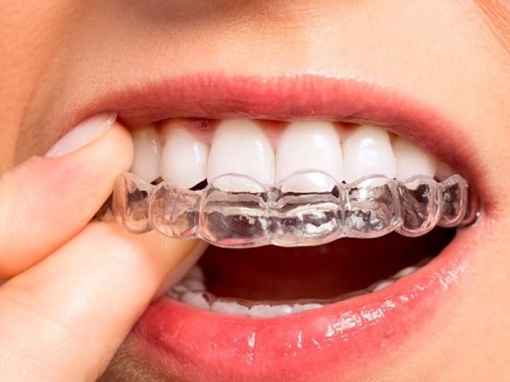 Як та навіщо носити елайнери: дбаємо про прикус