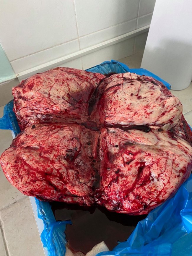 У волинській лікарні жінці видалили гігантську пухлину. ФОТО 18+