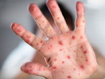 Через кір у школі під Луцьком пролонгували канікули