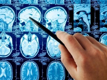 На Волині лікарі врятували жінку, у якої стався інсульт 