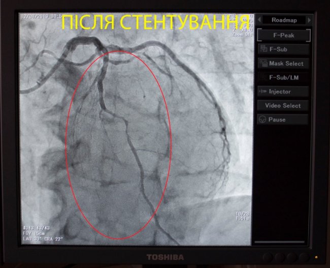 Волинські медики врятували пацієнта, в якого стався інфаркт міокарда. ФОТО