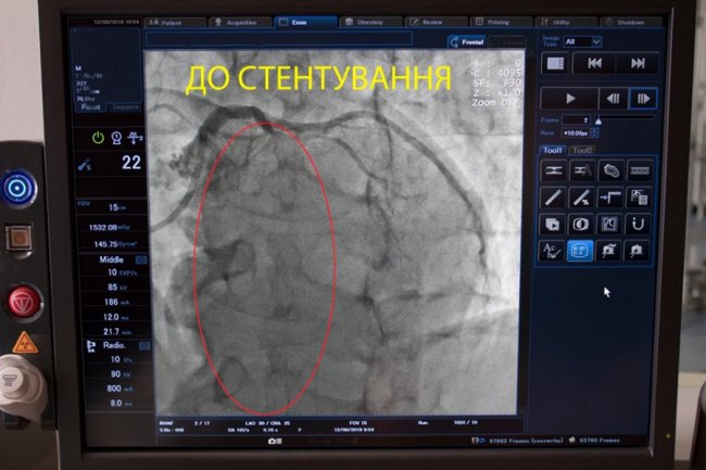 Волинські медики врятували пацієнта, в якого стався інфаркт міокарда. ФОТО