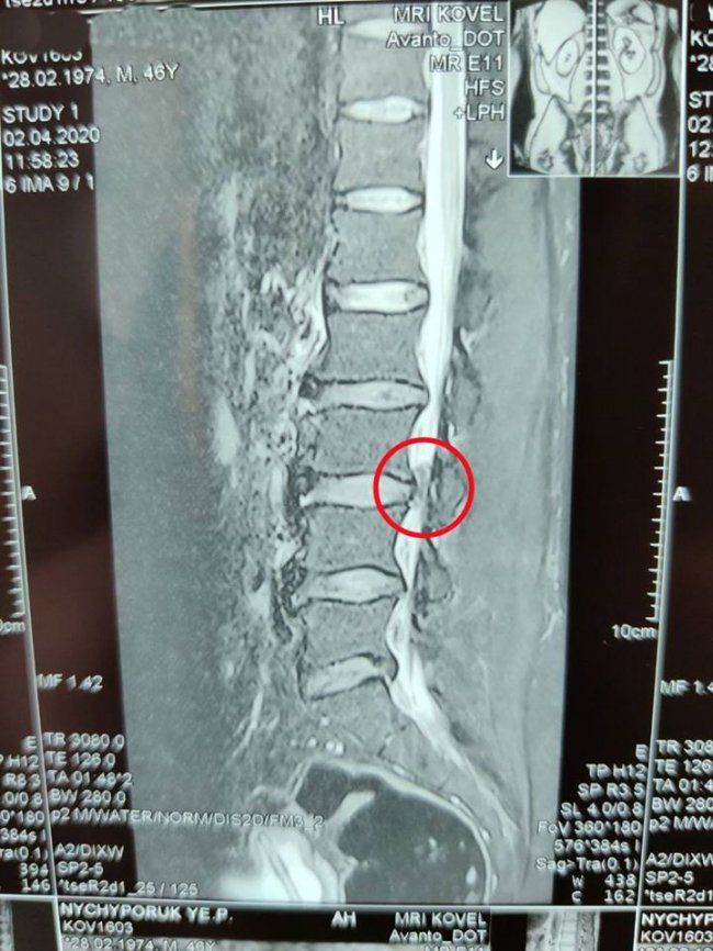 Волинські лікарі врятували життя чоловіку, у якого виявили грижу